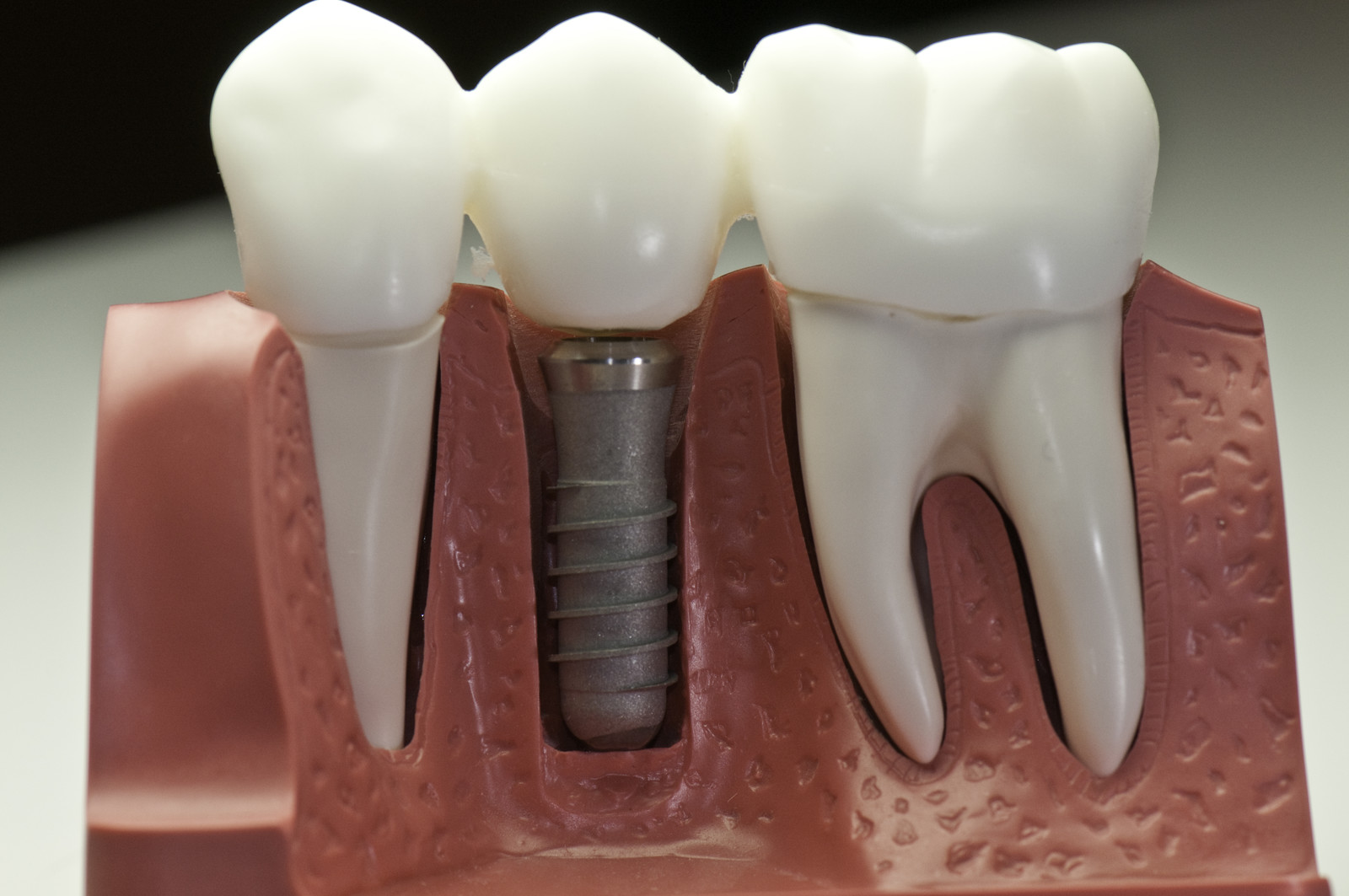 reasons why dental implants are popular