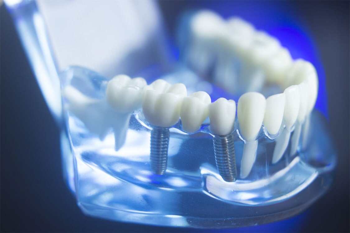 reasons you should consider dental implants