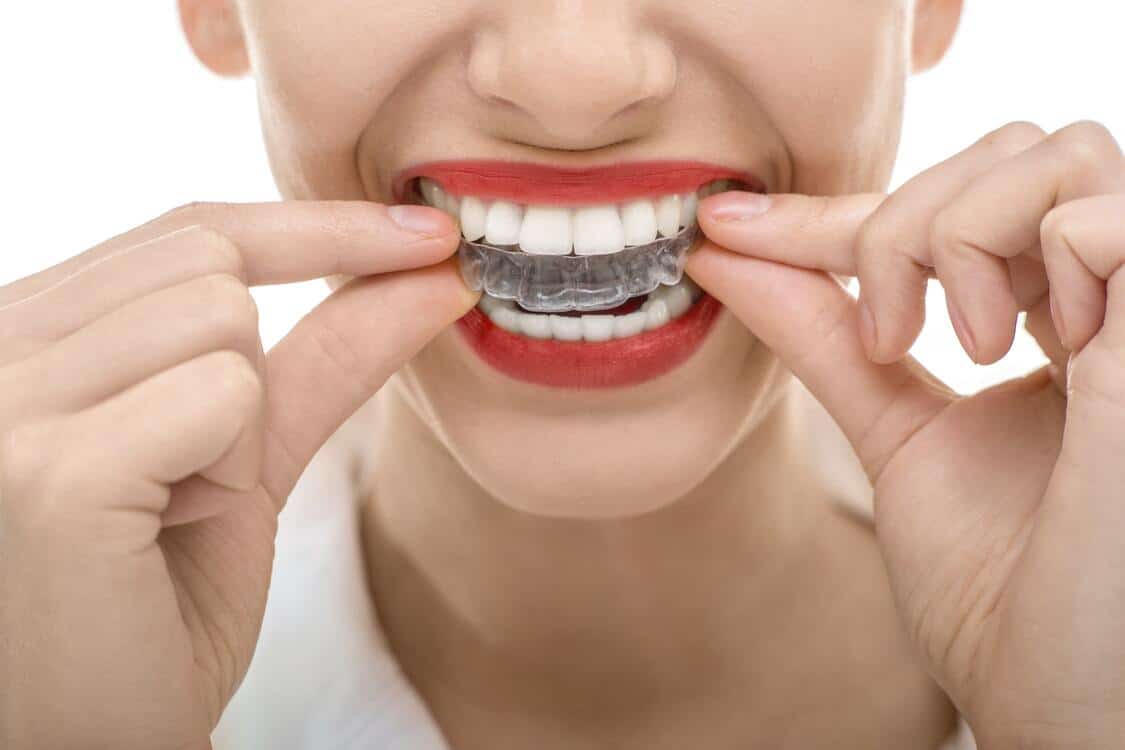 here is how invisalign can transform your smile