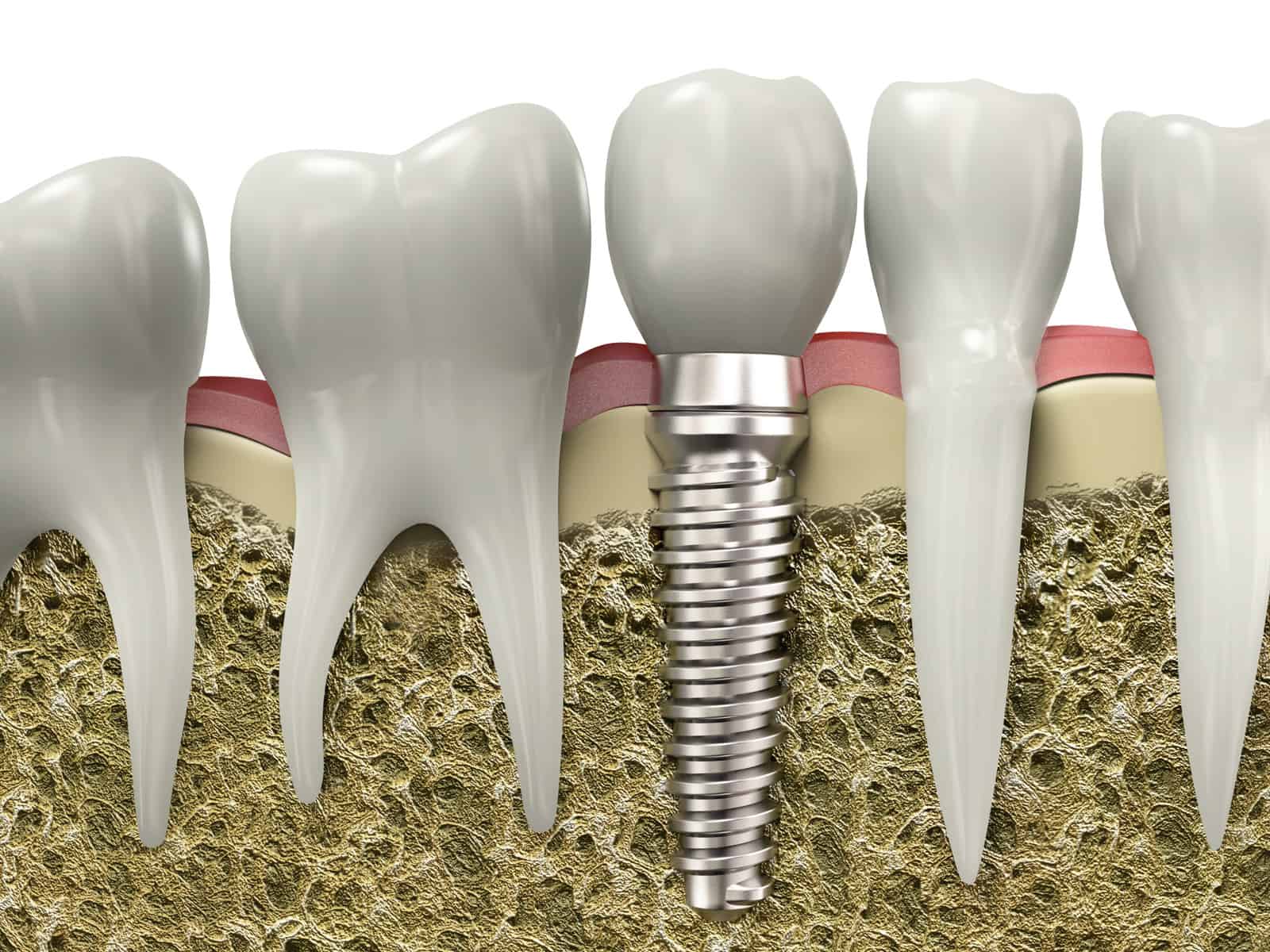 your dental implants cost explained