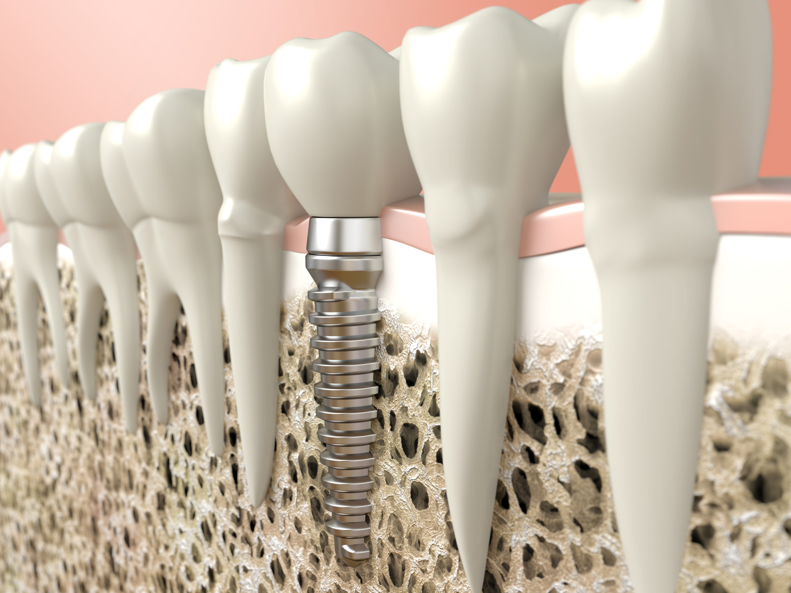 do you know if you are a suitable candidate for dental implants