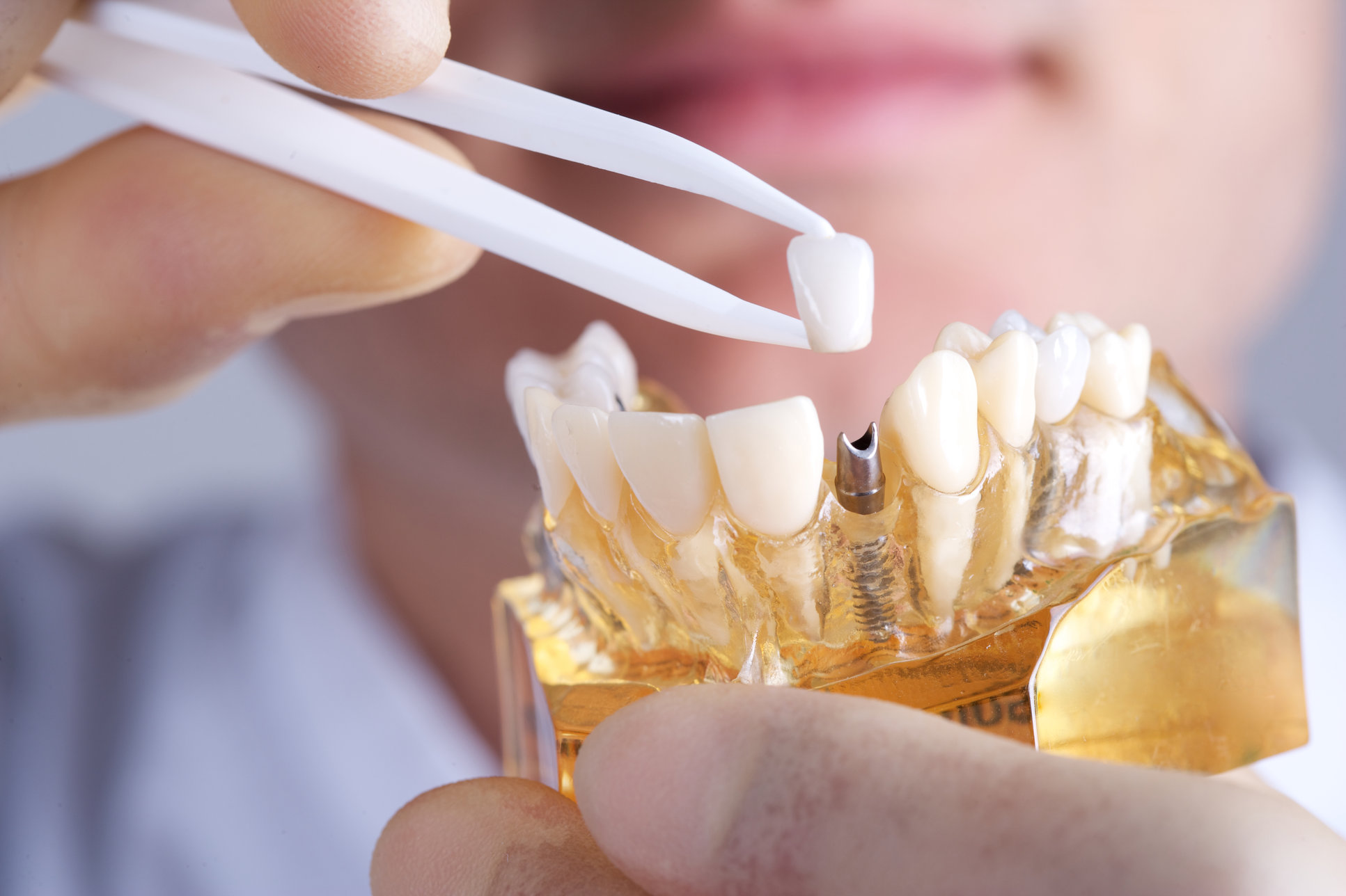 expect during and after a dental implant procedure