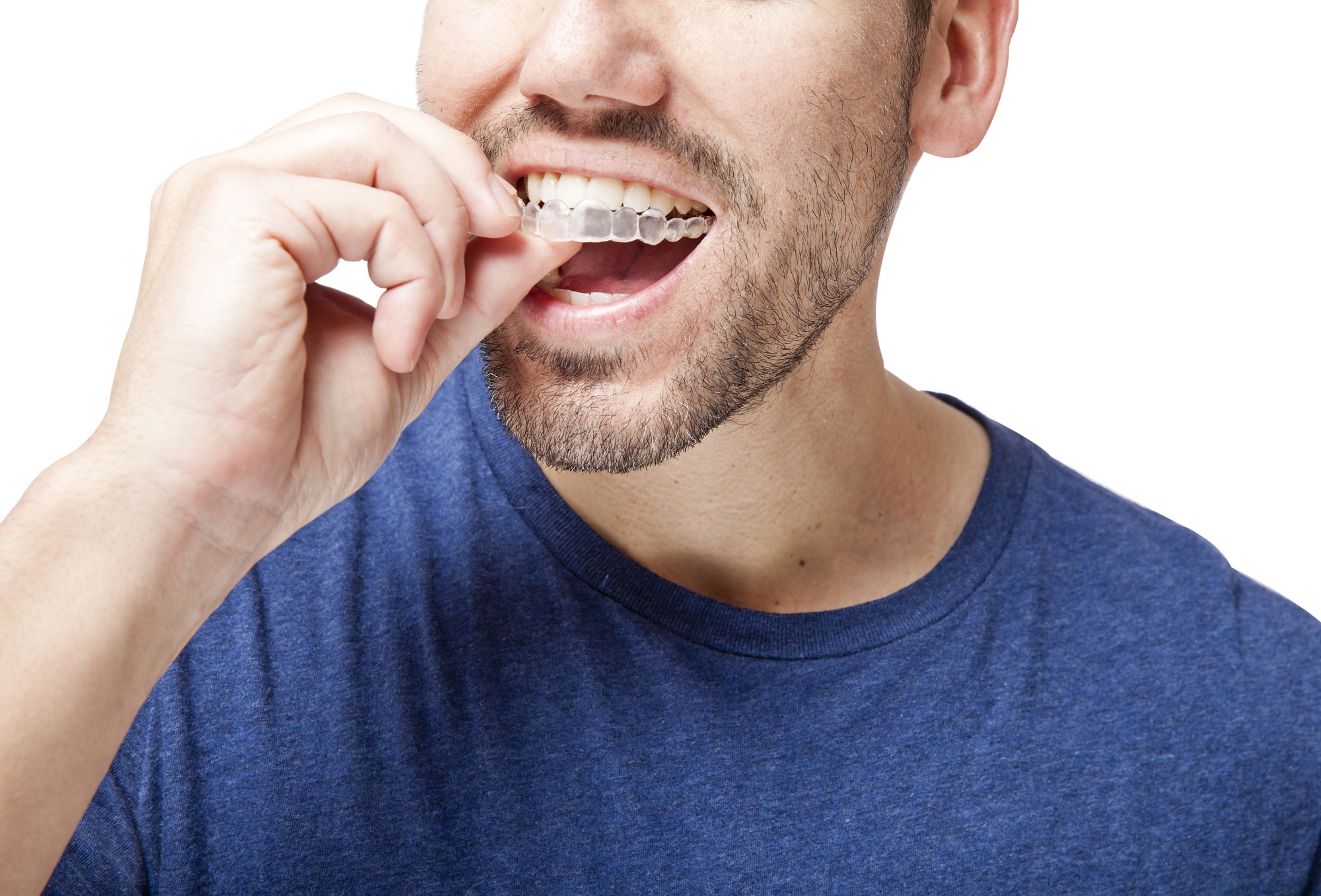 invisalign treatment in naples