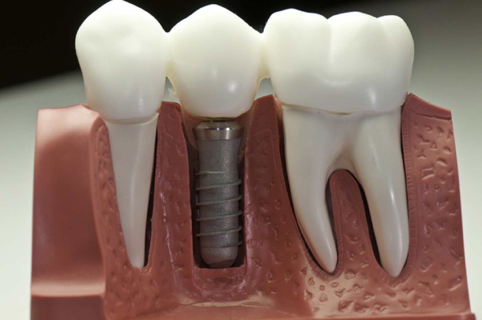 Dental Implant