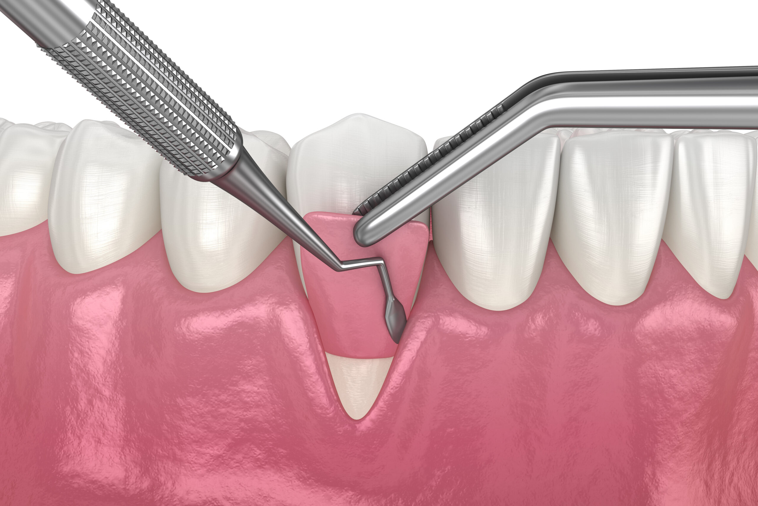 tips for gum graft recovery