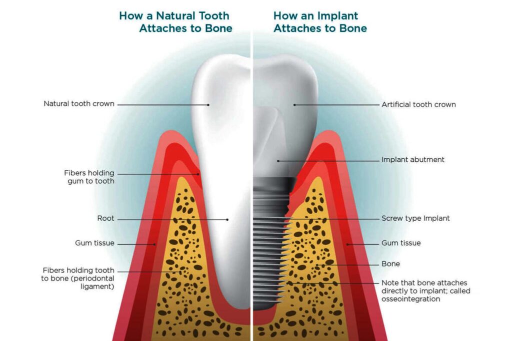 Osseointegration: the healing period dental implant