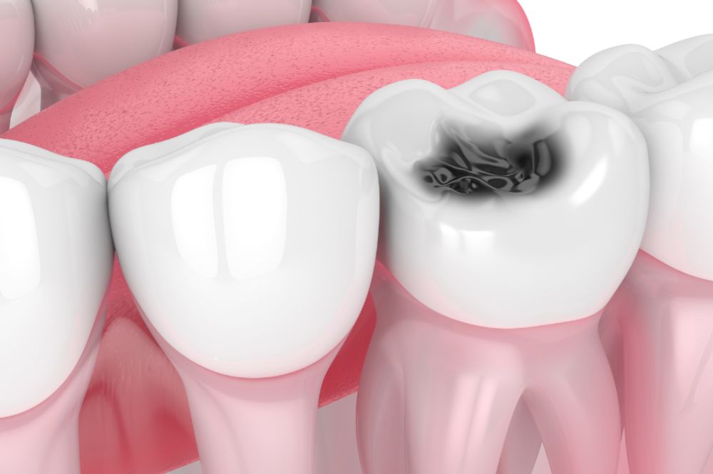 Tooth-Decay-Vs-Cavity